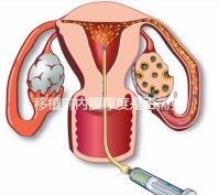 移植前內膜厚度是否需要降調,應注意什么速度