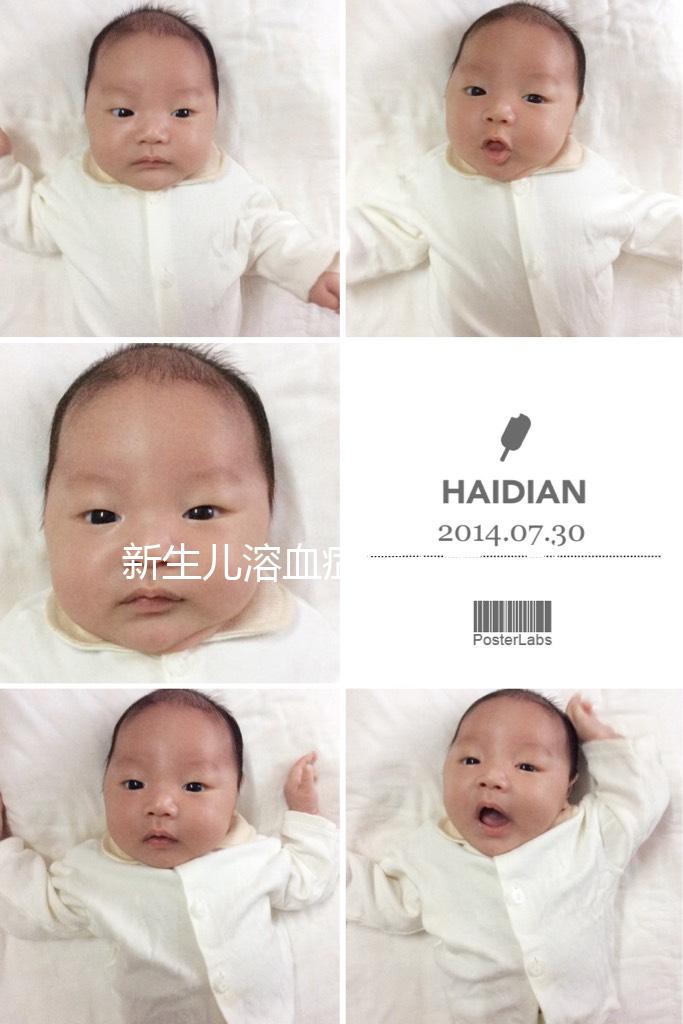 新生兒溶血癥危害大，引發膽紅素腦病可致神經后遺癥