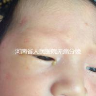 河南省人民醫院無痛分娩多少錢戳,收費標準60s看懂不踩坑